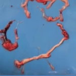 Fiberous white clots found by embalmers