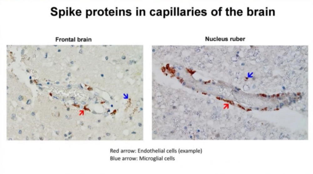 Spike-proteins-in-capillaries-of-the-brain
